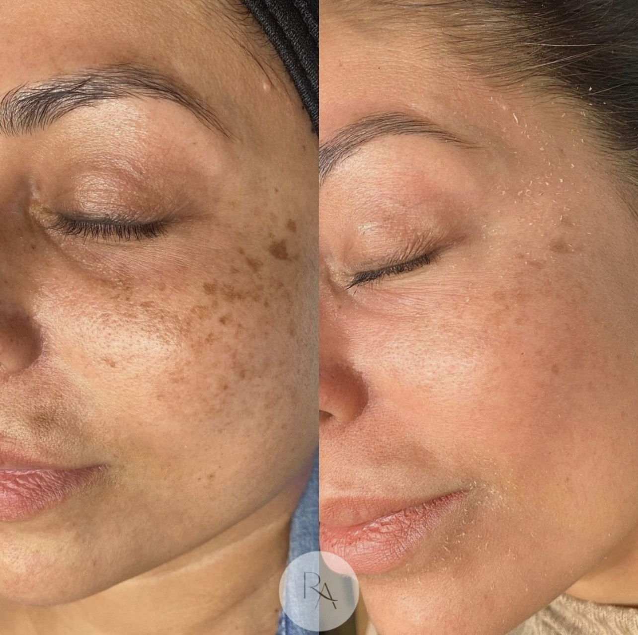 Womans face before and after Cosmelan Peel Melasma Treatment | Refined Aesthetics in Olmos Park, Texas